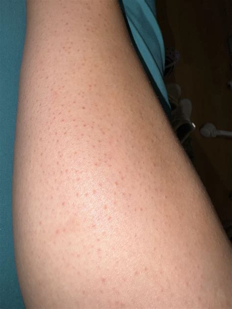 Red Bumps On Legs Red Spots On Skin: 19 Common Causes