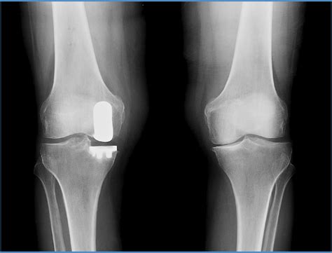 Mako Partial Knee Replacement - Orthopaedic Associates of Muskegon