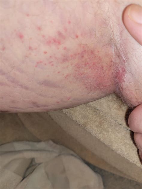 27 year old male rash between thigh and groin : r/medical_advice