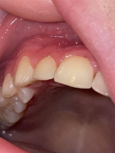 White Bumps On Gums
