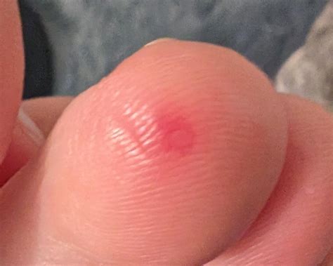 What are these red dots on my toes? : r/DermatologyQuestions