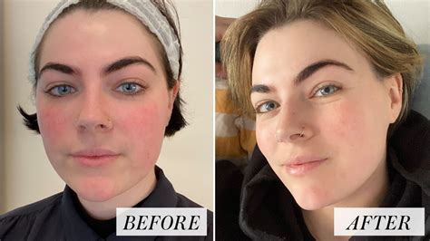 Review: How the ADVATx Laser Tamed My Rosacea With No Downtime — See Photos | Allure