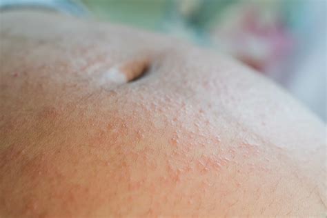 Prurigo Of Pregnancy
