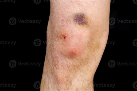 Knees bruised after a fall 48396303 Stock Photo at Vecteezy