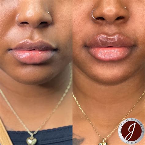 Russian Lip Augmentation
