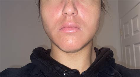 Ice burn? : r/DermatologyQuestions