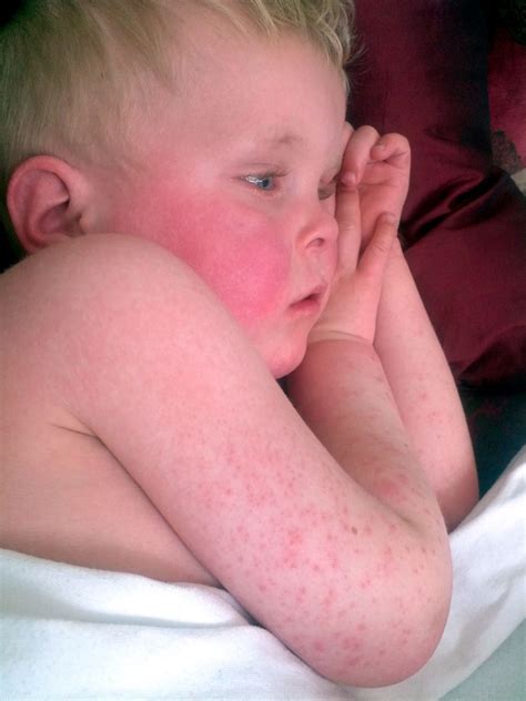 Scarlatina Rash in Children Pictures – 15 Photos & Images / illnessee.com