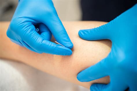 The Benefits of Trigger Point Dry Needling for Pain Relief: How it Can ...