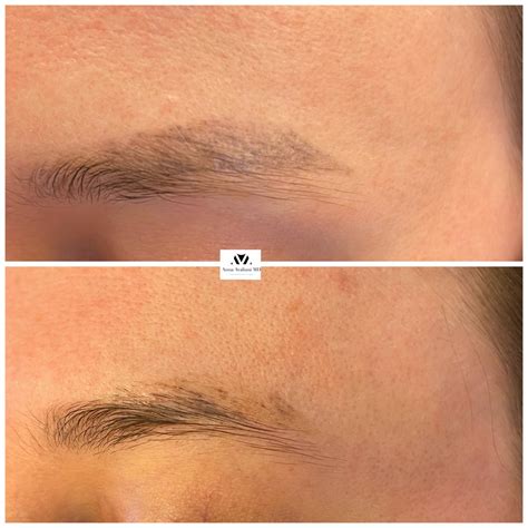 Gallery: Tattoo Eyebrow Removal - Anna Avaliani MD - Cosmetic & Laser Surgery Anna Avaliani MD ...