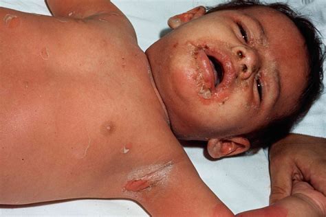 Scalded Skin Syndrome In Adults