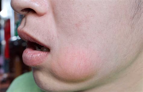 How To Reduce A Tooth Abscess Swelling at Linda Redmon blog