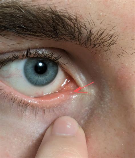 What's this blister? : r/Dryeyes