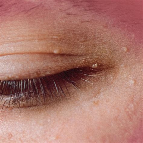 Why Do I Have White Spots In My Eyelids - Infoupdate.org