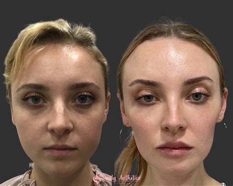 Masseter Reduction Botox Before and After: See the Powerful Transformation