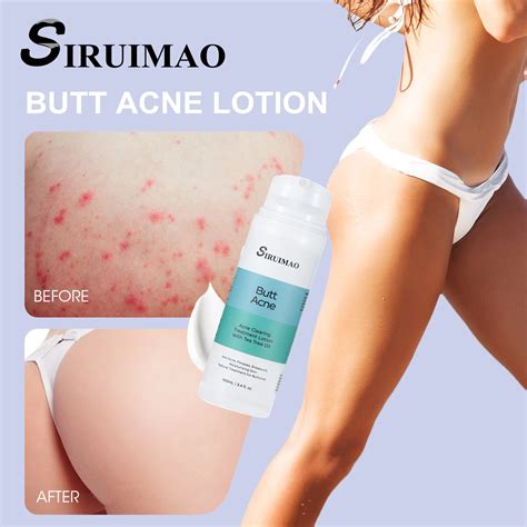 100ml Butt Acne Clearing Spot Treatment Cream Clears Acne Pimples Zits Razor Bumps and Dark Spot ...