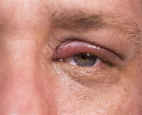 Eyelid Swollen Causes, Symptoms And Treatments For Puffy Eyes