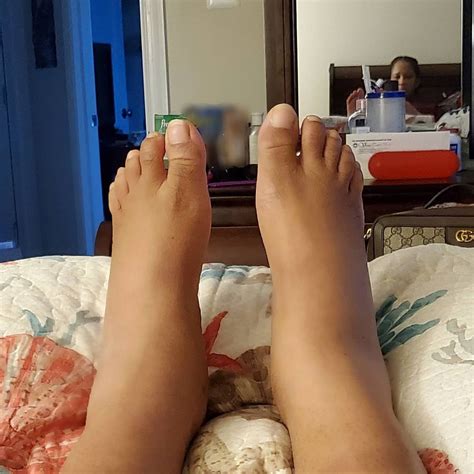 Feet Are Swollen After Giving Birth at Ruben Williams blog