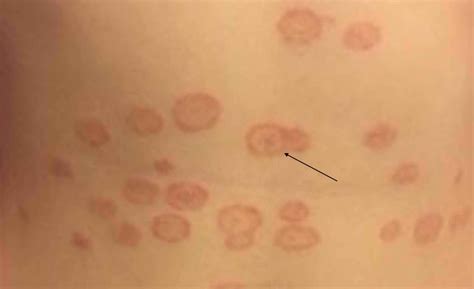 Tinea Versicolor Microscope at Bridget Huizenga blog