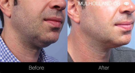 Double Chin Surgery For Men | Toronto Plastic Surgeons