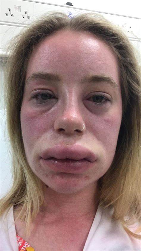Swollen Lip Allergic Reaction Cause at Roscoe Johnson blog
