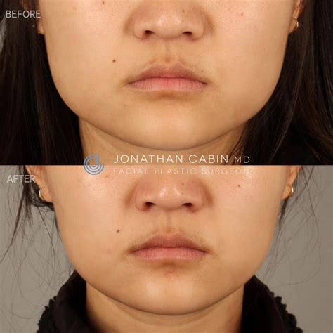 Facial Slimming Procedures Before & Afters | Dr. Jonathan Cabin