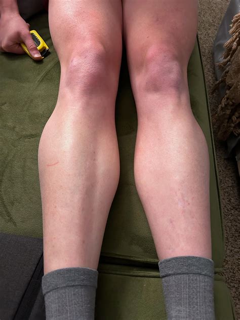 One sided calf pain and swelling? Hips, neck and back hurt too. What helps with this? : r ...