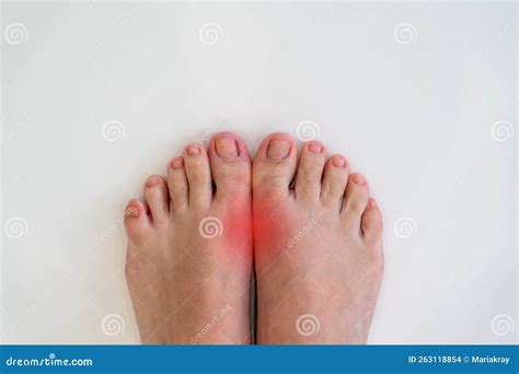 Feet Disease Rheumatism and Gout. Painful Gout Inflammation on Big Toe Joint with Red Spots ...