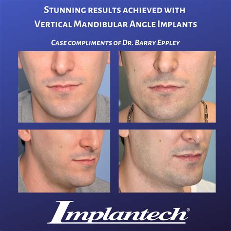 Check out the amazing results Dr. Eppley achieved with this patient using Vertical Mandibular ...