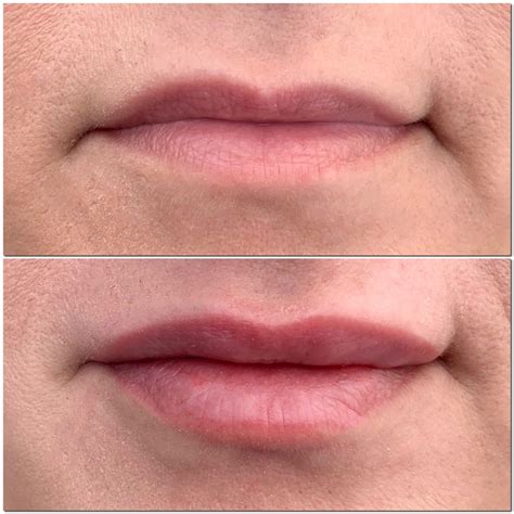 Hyaluron Pen lip Filler Before and After