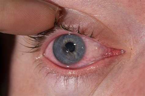 Scratched Cornea vs. Pink Eye: Signs to Tell the Difference