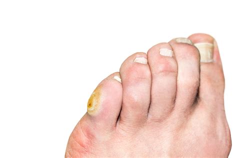 Callus On Pinky Toe