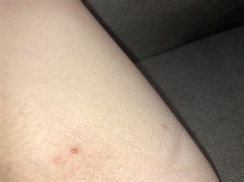 What are these small bumps in my inner thigh and how do I get rid of ...