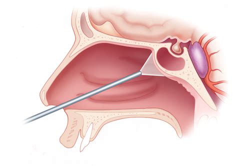 Use of Endoscopes in Skull Base Surgery – Skull Base Surgery Atlas