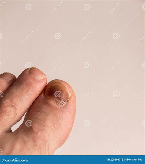 A Bruised Finger after a Blow, a Bruise on the Finger Stock Image - Image of human, disease ...