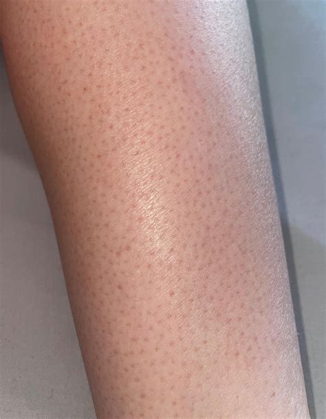 Dark Spots On Legs