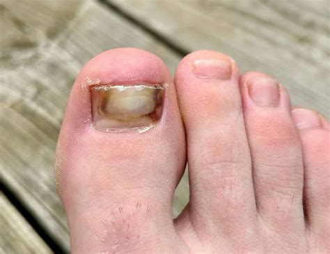 Tips For When Your Toenail Is on The Verge Of Falling Off - Feet First ...
