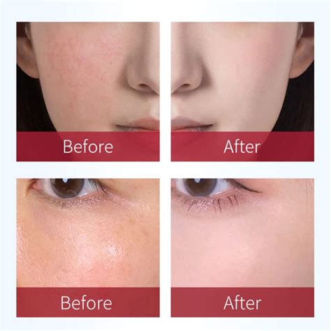 Rosaderm Fast Gel Cream 30g - Corrective Anti-Redness Treatment, Soothing Hydro Primer for ...