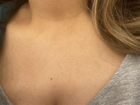 Why Is My Chest Skin So Rough at Kevin Davidson blog