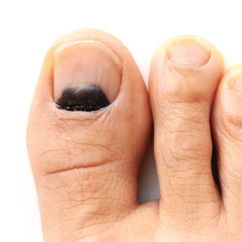 Should I worry about a bruised toenail? | The Foot Hub