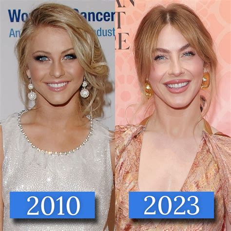 Julianne Hough Face Surgery