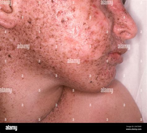 Face of a 7 year old male patient with xeroderma pigmentosum (XP). XP is a genetic defect that ...