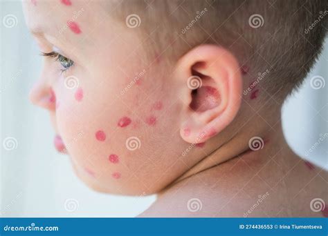 Portrait of a Boy with a Rash on His Face from Chicken Pox. Stock Image ...