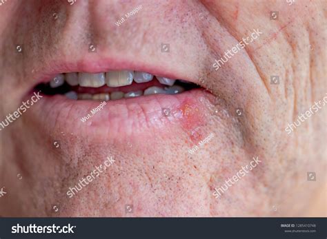 Lips With Herpes Simplex at Betty Mcclusky blog