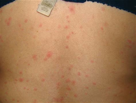 Flu-like illness—and a rash - The Lancet