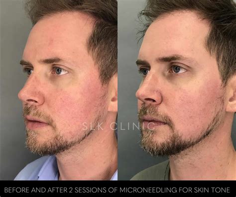 Microneedling in Nashville & Chattanooga | SLK Clinic