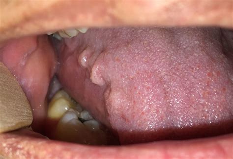 Scalloped Tongue Causes, Pictures, Hypothyroid, Diagnosis & Treatment - American Celiac