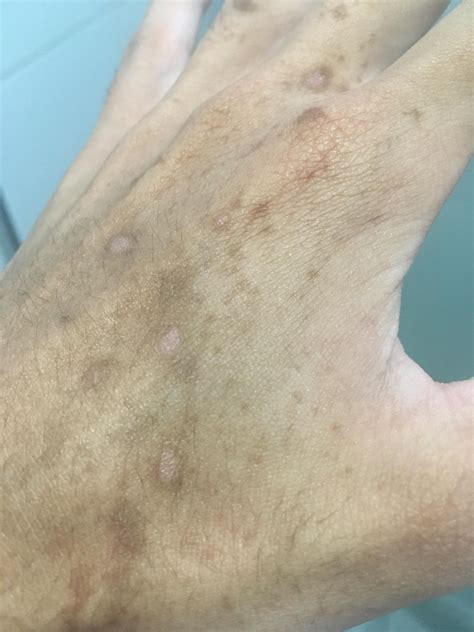 M/20 - brown spots appeared only on my left hand overnight , then white dots appeared after a ...