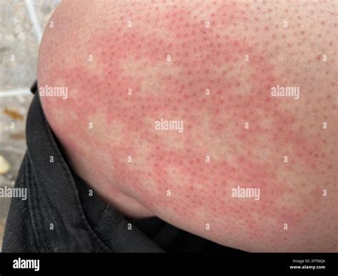 Livedo reticularis hi-res stock photography and images - Alamy