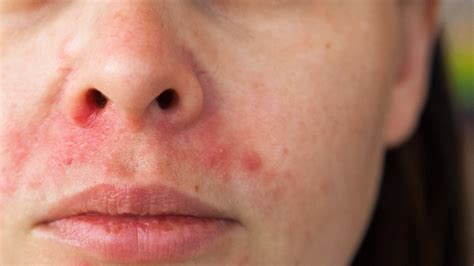 Perioral Dermatitis: Causes, Symptoms, Treatment | Gladskin