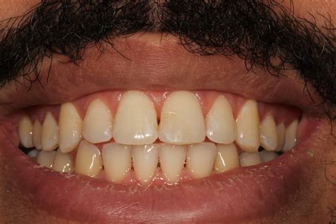 Dental Bonding In NYC | Before And After Photos